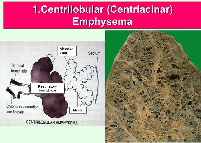 Centriacinar Emphysema