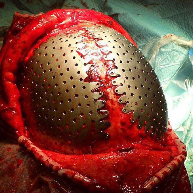 Cranioplasties applied with screws