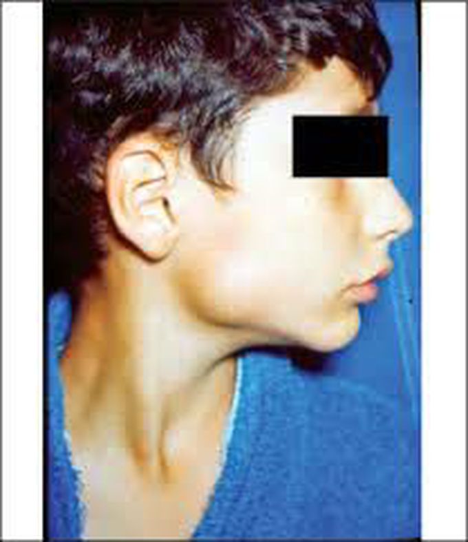 Juvenile recurrent parotitis