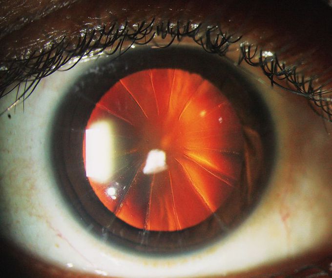 Eyeball