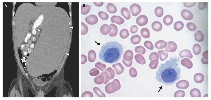 Massive Splenomegaly In Hairy-Cell Leukemia - MEDizzy