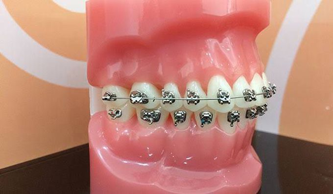 How do braces work?