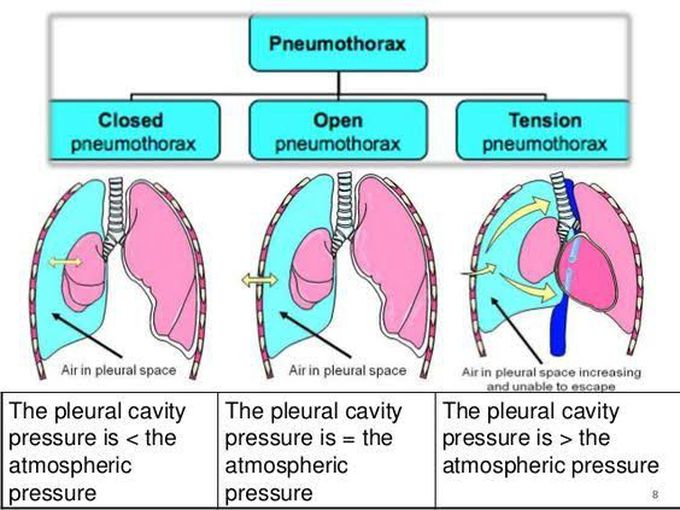 Types of Pneumothorax