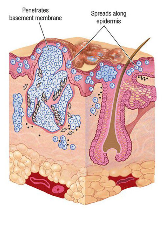Melanoma