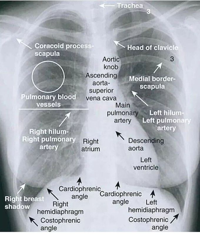 Abc Of Reading Chest X Ray