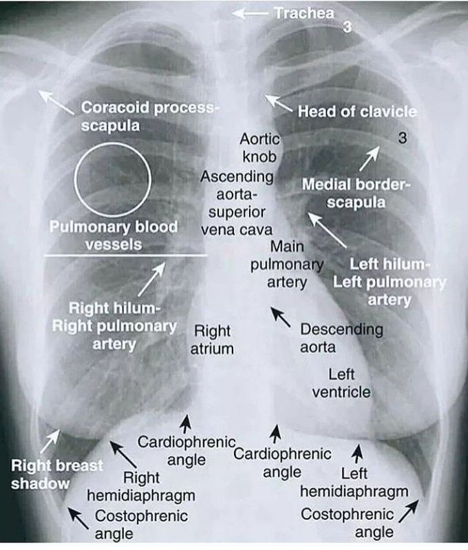 Chest X ray Interpretation MEDizzy