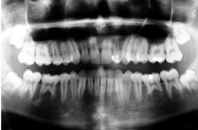 External resorption