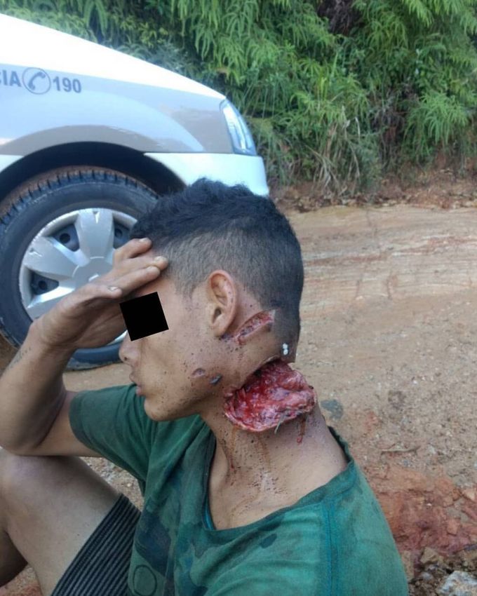 ⚠️ Man survives machete attack with huge wound in his neck! 