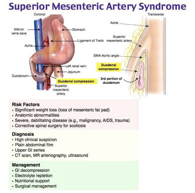 Superior Mesenteric Artery Syndrome