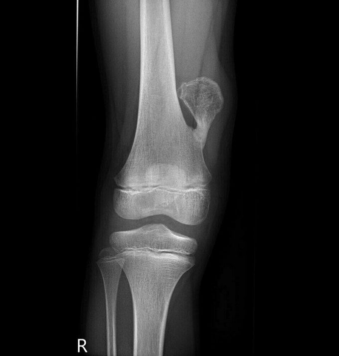 Distal femoral osteochondroma