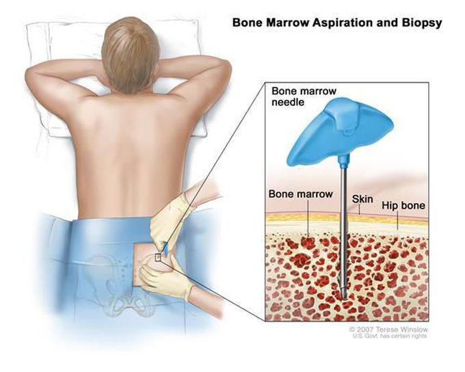 BONE MARROW BIOPSY