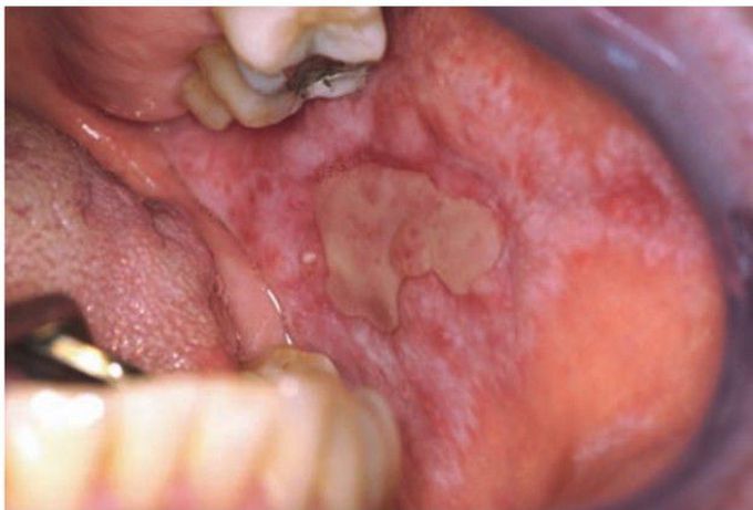 Erosive lichen planus