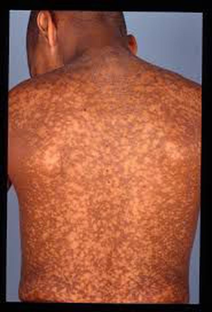 Dyskeratosis congenita