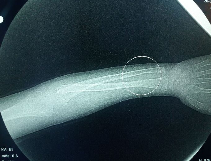 Green stick fracture