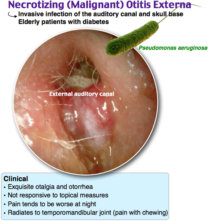 otitis externa maligna pseudomonas