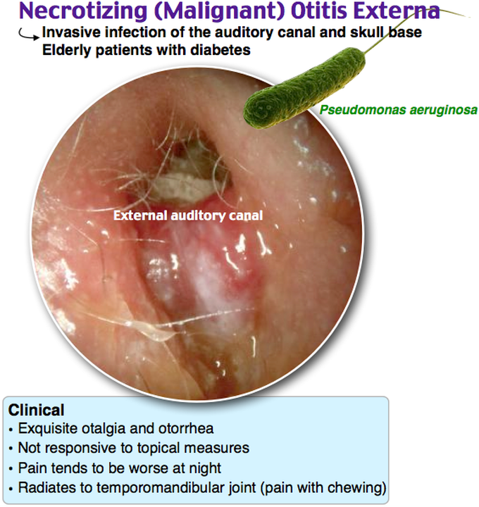 Get Malignant Otitis Externa Prognosis Pics