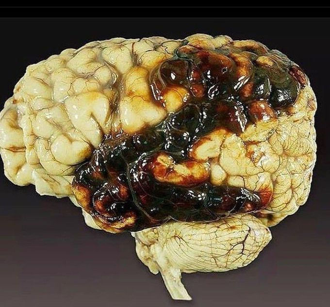 Intra Cranial Hemorrhage