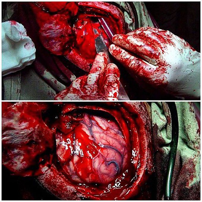 Removal of a subdural hematoma