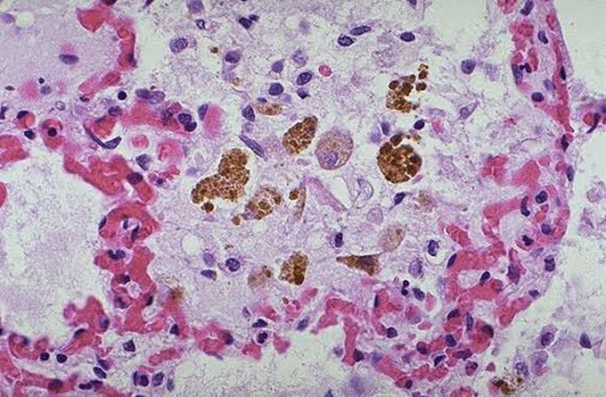 heart failure cells or siderophages