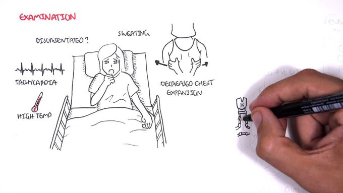 Community Acquired Pneumonia (DETAILED) Overview