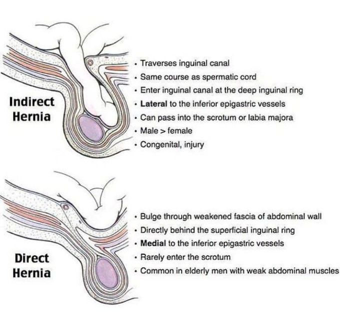 Direct Vs Indirect Hernia