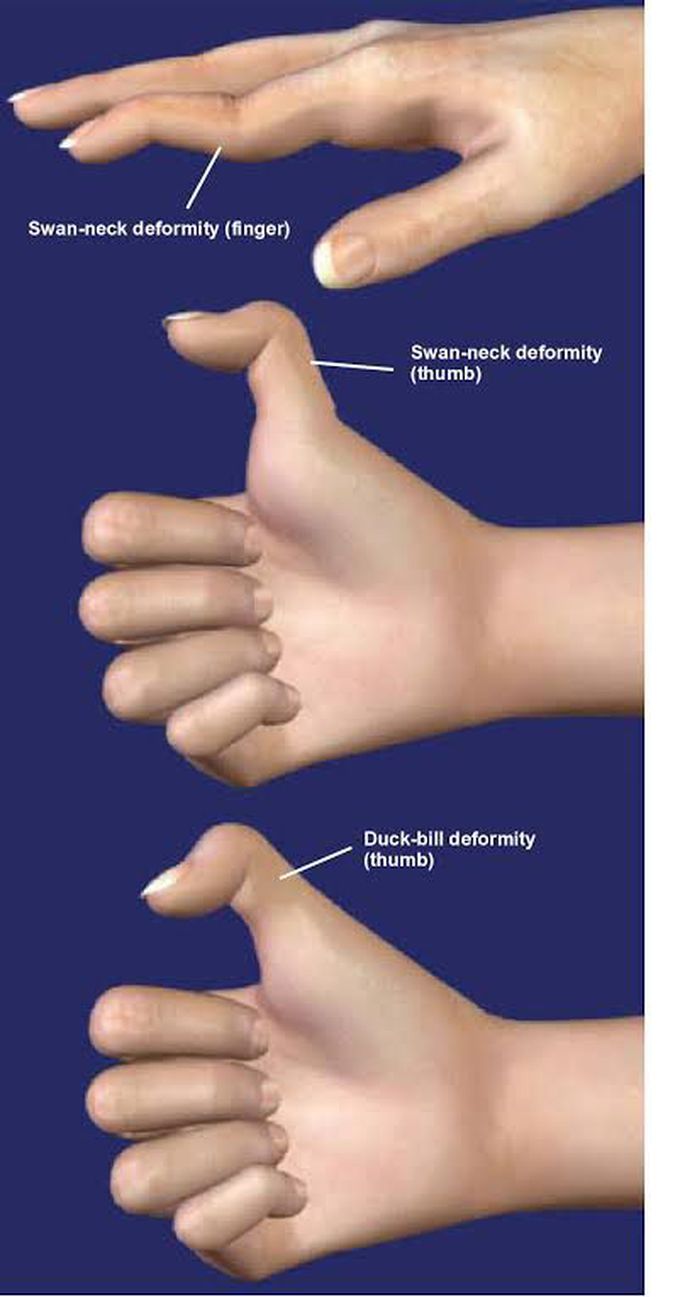 Swan neck deformity