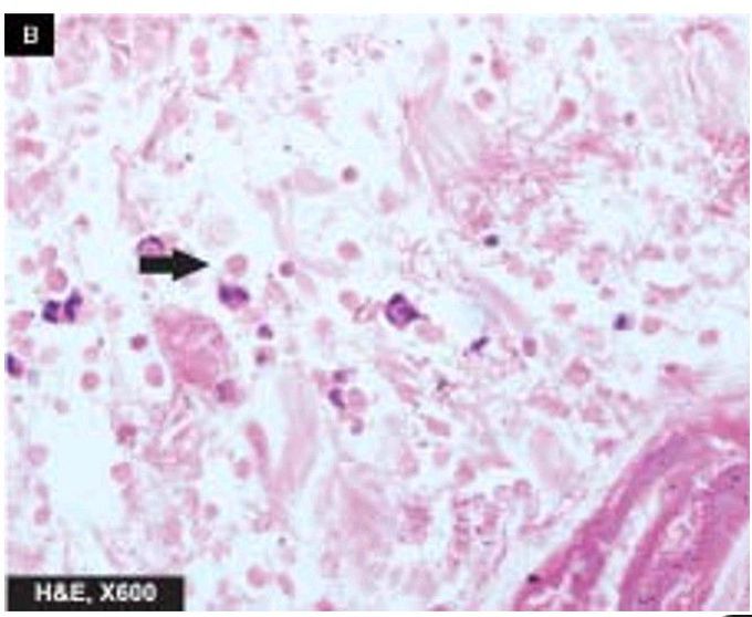 Amoebic ulcers large intestine