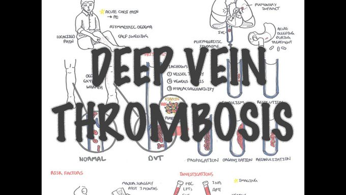 Deep Vein Thrombosis