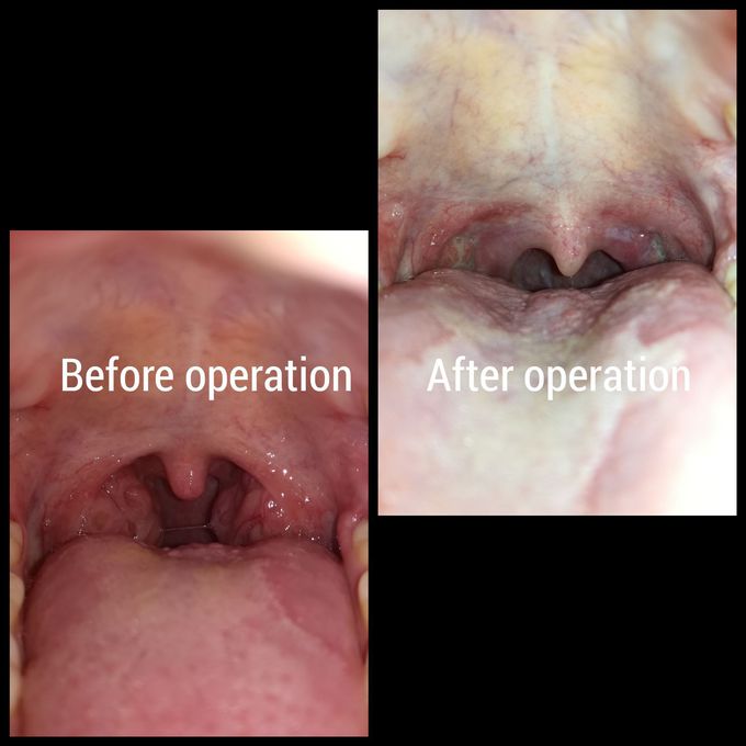 Tonsillectomy