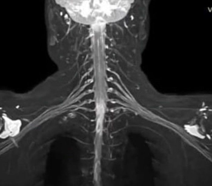 brachial plexus anatomy mri