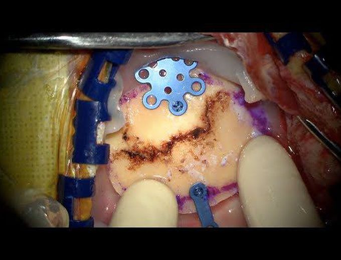 Brain tumor: Surgical removal of glioblastoma using fluorescein sodium guidance
