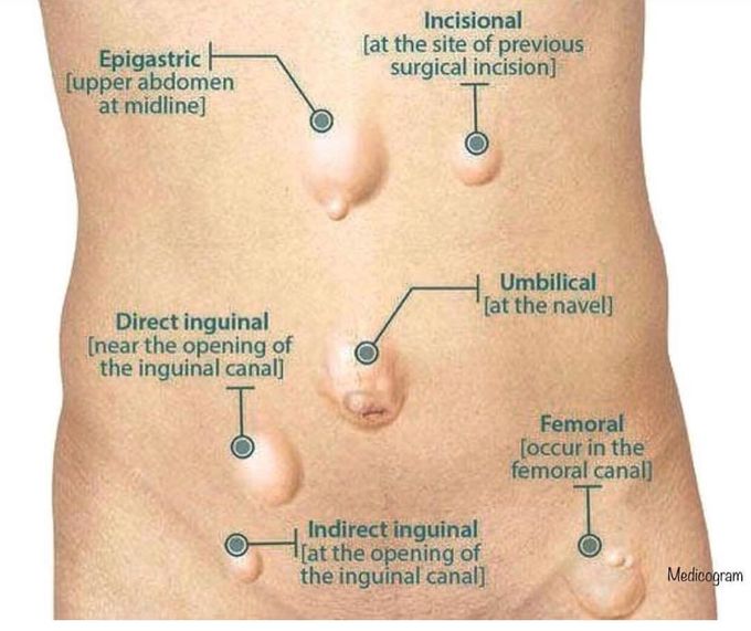 Hernia and its types