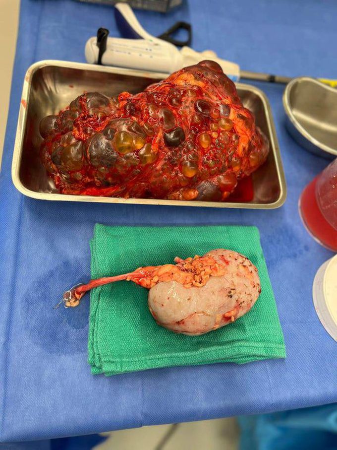 Kidney with polycystic kidney disease vs healthy transplant kidney