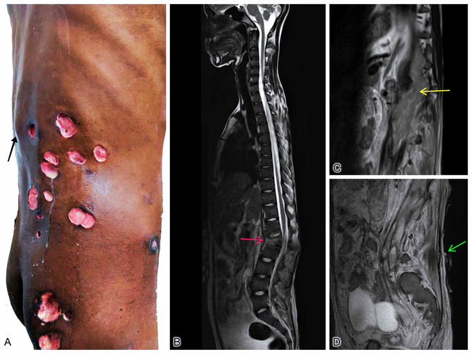 Pott's Spine