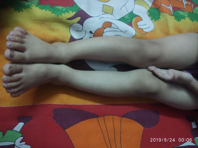 Congenital bow legs.What treatment should be done?