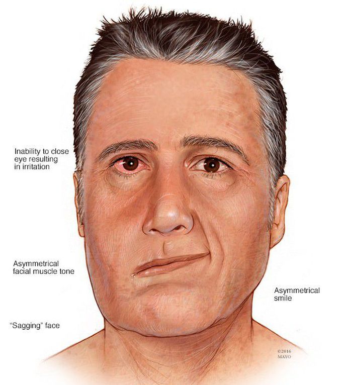 Ramsay Hunt syndrome