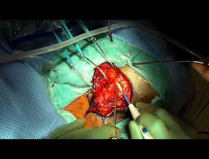 Resection of a cystic brainstem hemangioblastoma via a retrosigmoid approach
