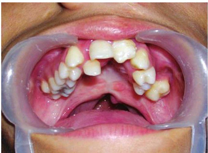 Crouzon's syndrome