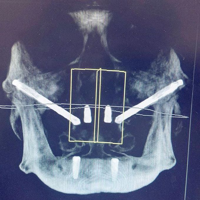 Treatment planning zygomatic implants on this patient's 3D reconstruction for full mouth rehabilitation 😄🙌 • 