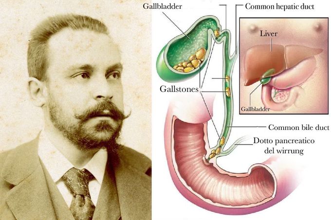 What happens after a cholecystectomy?