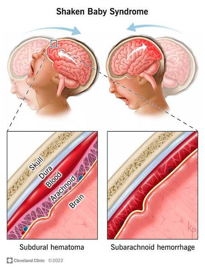 Prevention from shaken baby syndrome