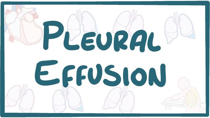 Pleural Effusion