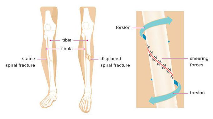 Spiral fracture