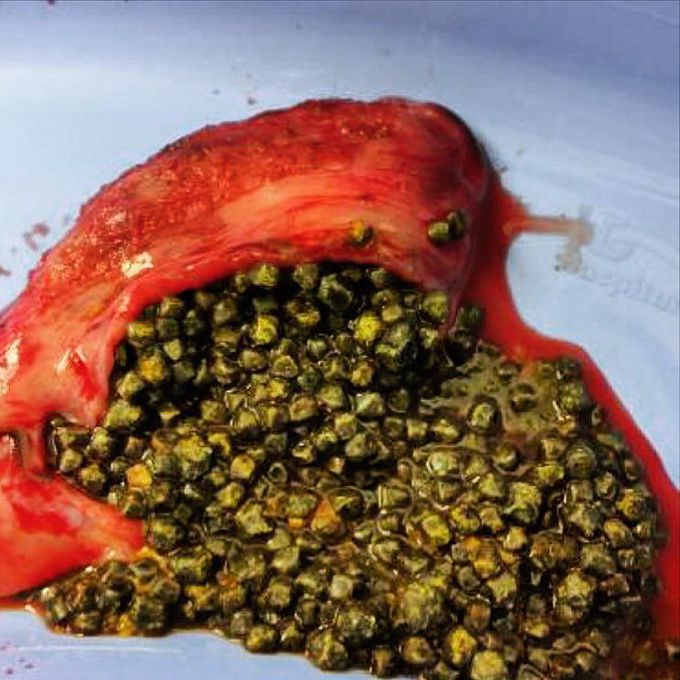Gallbladder full of stones!!!