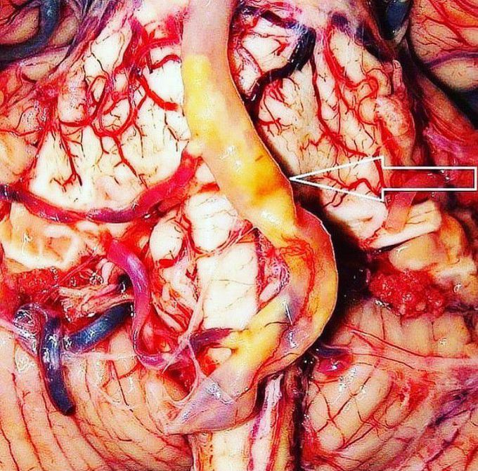 Atherosclerosis of the basilar artery