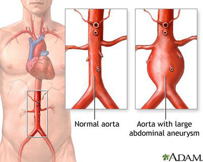 Symptoms of abdominal aortic aneurysm