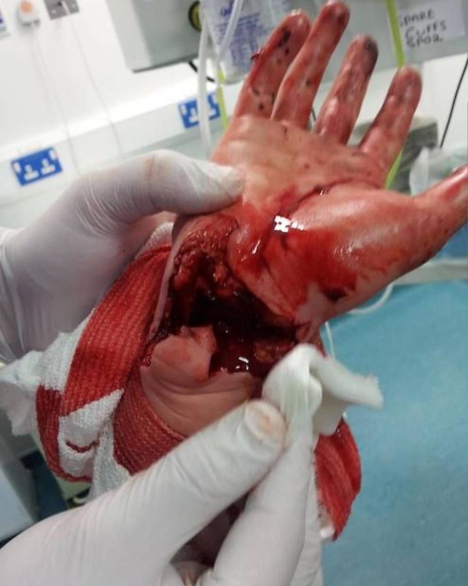 Massive injury to the wrist. 