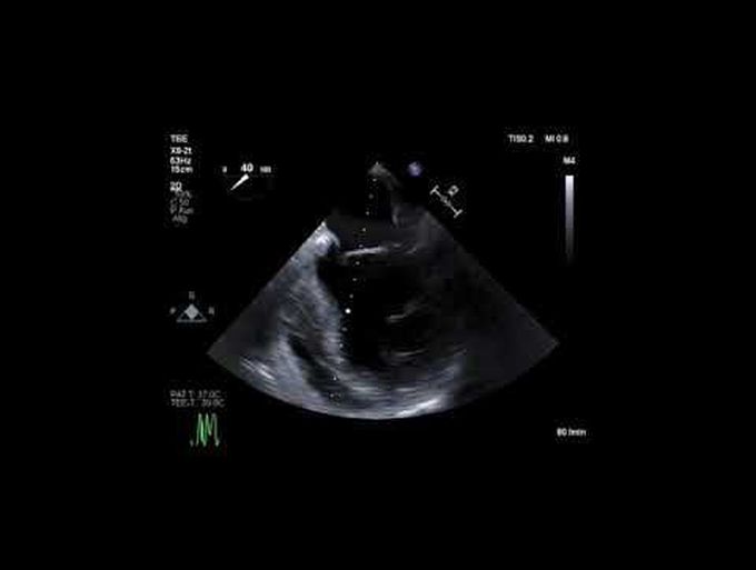 Percutaneous Impella LD Explantation