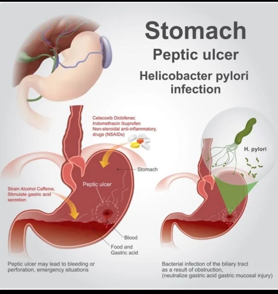 Do Peptic Ulcers Feel Better After Eating