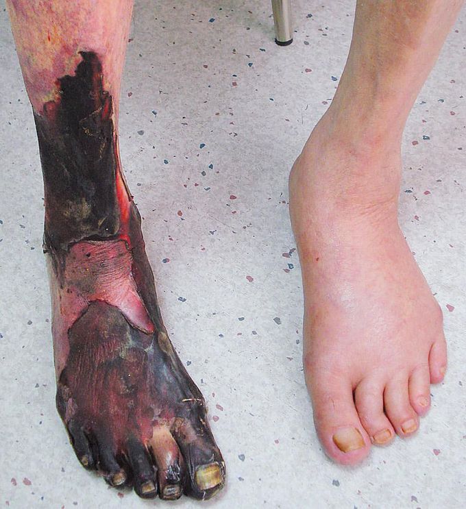 Ischemic dry gangrene!  